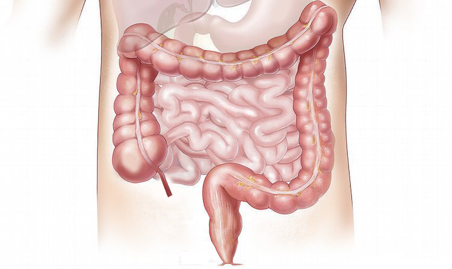 Le dostarlimab, efficace à 100 % contre le cancer rectal