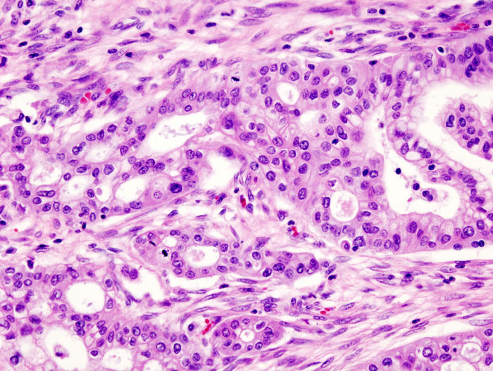 Le DTI (Imagerie par Tenseur de Diffusion) ouvre de nouvelles perspectives dans le dépistage précoce du cancer du pancréas.