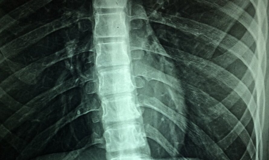 Spasticité Musculaire: Une Nouvelle Méthode pour la réduire