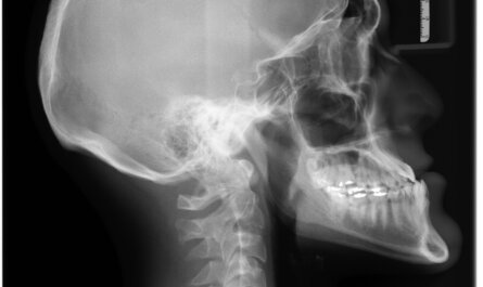 xray, x-ray, radiology, scan, technology, radiological, grayscale, hospital, healthcare, diagnosis, medical, diagnostic, exam, medicine, crooked, teeth, braces, orthodontics, dentistry, yellow, tooth, underbite, jaw surgery, side, skeleton, gray hospital, gray medical, gray medicine, gray teeth, gray healthcare, xray, xray, xray, xray, xray, x-ray, radiology