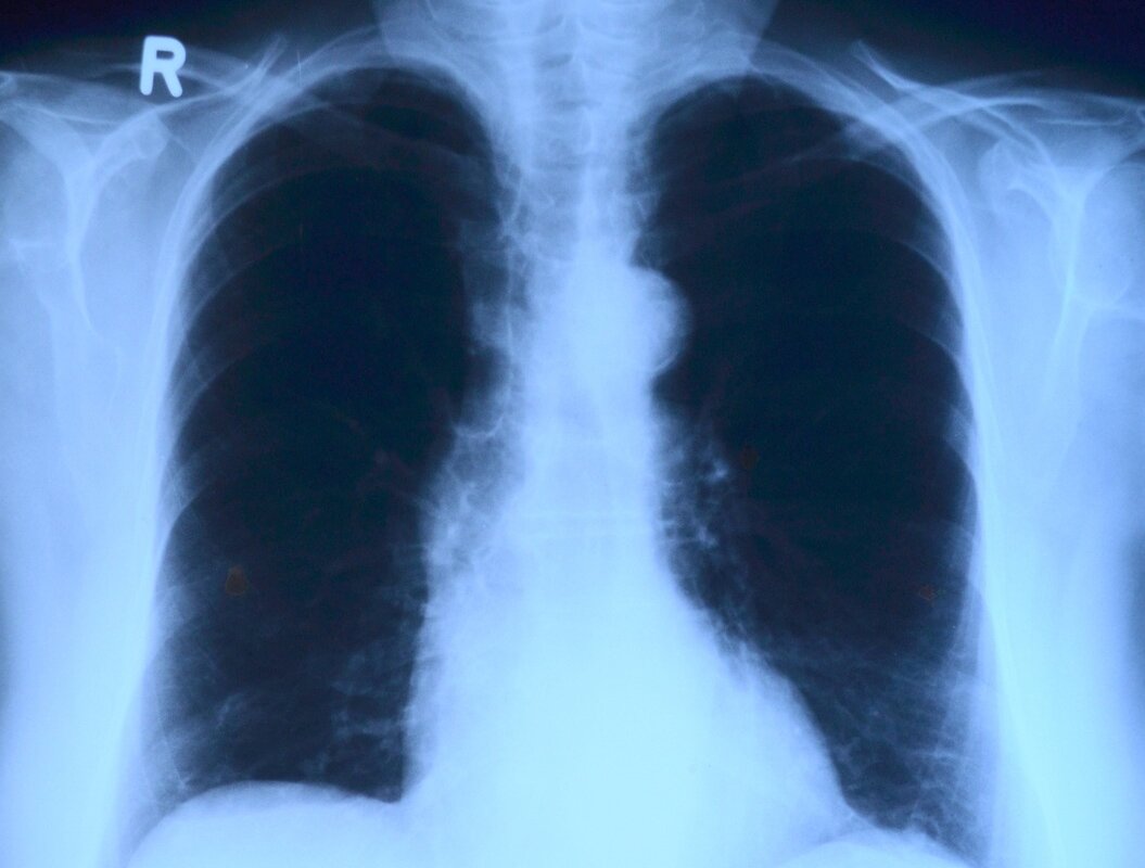 x-ray image, roentgen, thorax