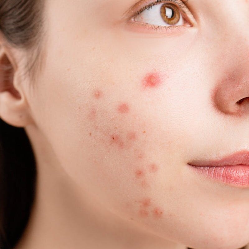 A detailed close-up of a woman's face showing acne blemishes on her skin.