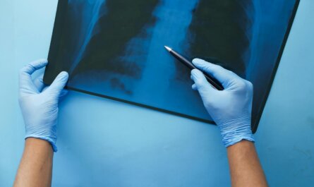 A doctor in blue gloves examines a chest x-ray with a pen, focusing on medical diagnosis.