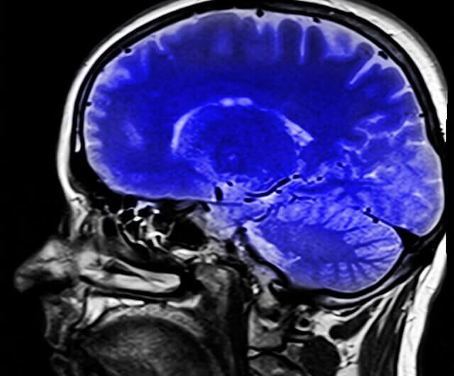 Ruvimbo Kaviya: cette patiente qui s’est faite retirer une tumeur du cerveau jugée inopérable en passant par la cavité orbitale de l’oeil